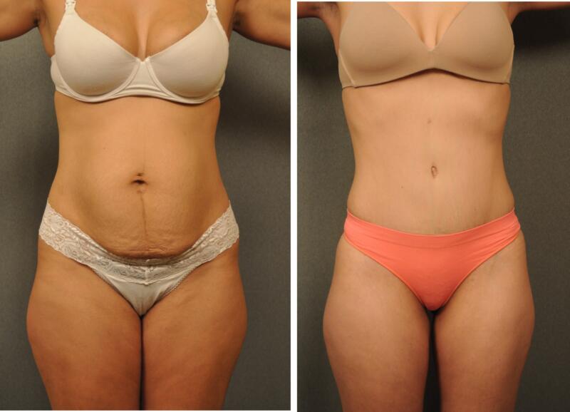 Natural Tummy Tuck At Home Natural Tummy Tuck At Home