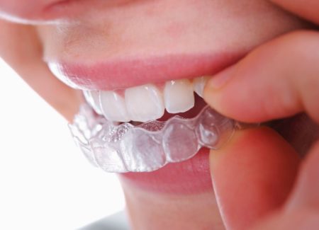 Dental Braces Structural and Aesthetic Benefits and How They Work